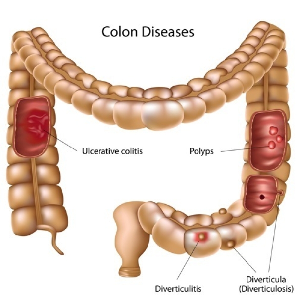 Ülseratif kolit ve Crohn hastalığında kolorektal kanser riski;