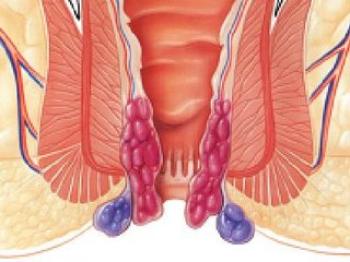 ANAL FİSSÜRLERDE BOTOX